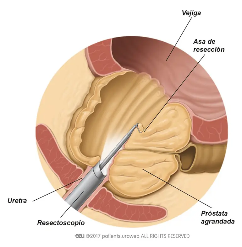 Antes y después de cirugía HOLEP - Resultados reales
