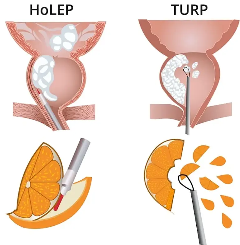 Procedimiento de enucleación prostática con láser HOLEP en CDMX