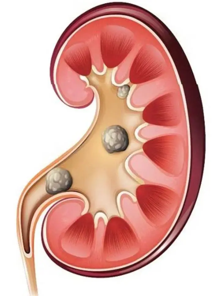 Cuidados y síntomas enfermedades piedras vías urinarias, mujeres, urologo, dr edgar beltrán, cdmx